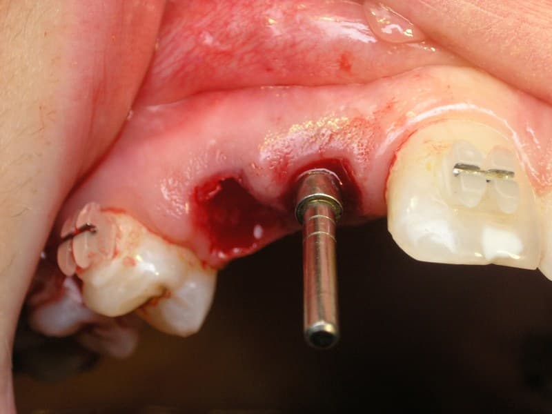 На 1 ренгеновском снимке мы видим молочные зубы с маленькими корнями, с левой стороны в области второго резца проблема – резорбция.