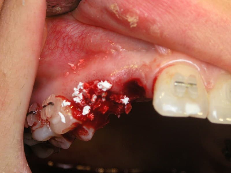 Рис. 3. В связи с тем, что был дефект при молочных зубах, происходило рассасывание  костной ткани, была использована подсадка костного материала (Bio-oss - швейцарской фирмы «Gestrich»)
