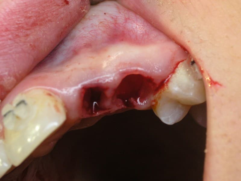 Мал. 5. Показане місце видаленого молочного зуба з практично розсмоктаним коренем