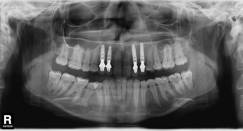 2 Рентгеновский снимок. В связи с тем, что молочные зубы были с маленькими корнями, и с левой стороны в области второго резца была резорбция, были установлены импланты, индивидуальные циркониевые абатменты (временные коронки) и постоянное протезирование.