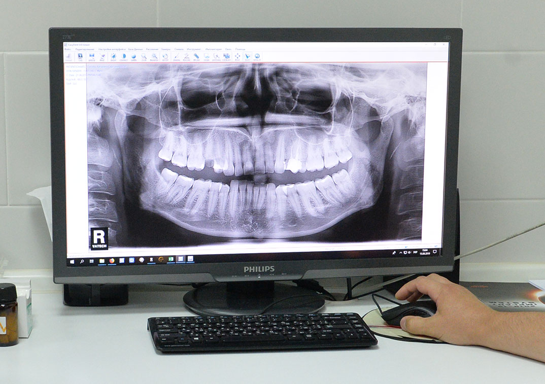 На 1 рентгеновському знімку ми бачимо молочні зуби з маленькими коріннями, з лівого боку в області другого різця проблема - резорбція.